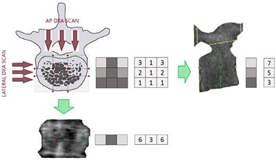 Beyond Bone Mineral Density: A New Dual X-Ray Absorptiometry Index of Bone Strength to Predict Fragility Fractures, the Bone Strain Index